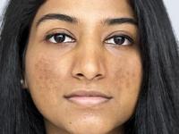 कशाला महागडे फेसवॉश हवे? 'या' पद्धतीने चेहऱ्याला जायफळ लावा- पिंपल्स, वांगाचे डाग कमी होतील - Marathi News | use of jayafal or nutmeg for removing pimples, acne and pigmentation, how to use jayafal for glowing skin | Latest sakhi Photos at Lokmat.com