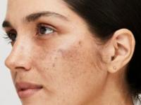 कपाळ काळे, गाल गोरे असे चेहऱ्यावर पॅचेस दिसतात? 'हा' लेप लावा- वांगाचे डागही जातील - Marathi News | use of mulethi or jyeshthmadh for getting even skin tone, home made face pack for pigmentation, how to get rid of pigmented skin | Latest sakhi Photos at Lokmat.com