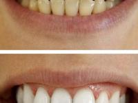 दात पिवळे, दातांवरचा पिवळट थर हसताना दिसतोच? ५ उपाय, दात दिसतील स्वच्छ-कीड लागणार नाही - Marathi News | the yellow layer on the teeth is visible when you smile? 5 solutions, teeth will look clean | Latest sakhi Photos at Lokmat.com