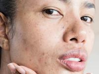 धूळ, ऊन यामुळे त्वचा खूपच रखरखीत- डल झाली? ५ सोप्या टिप्स- त्वचेचं सौंदर्य खुलून येईल - Marathi News | 5 skin care tips for dry and dull skin in summer, skin care routine in summer, how to take care of skin in summer | Latest sakhi Photos at Lokmat.com