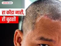 कोंडा नाही, ही टाळूवर बुरशी; दुर्लक्ष कराल तर होईल टक्कल; काय आहे निदान आणि उपचार - Marathi News | It's not dandruff, it's a fungus on the scalp; If you ignore it, it will lead to baldness; What is the diagnosis and treatment? | Latest maharashtra Photos at Lokmat.com