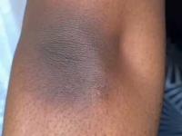 कोपरांवर काळपट थर-हातपाय काळवंडले? ७ घरगुती उपाय, त्वचा दिसेल स्वच्छ तेजस्वी - Marathi News | Elbow Tanning Removal Tips : 7 Pro tips To Remove Elbow Tanning Beauty Hacks | Latest sakhi Photos at Lokmat.com