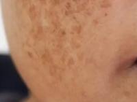 वर्षांनुवर्षे जुने पिगमेंटेशन ३० दिवसांत होतील गायब, लावा पपईचा 'हा' फेसमास्क, त्वचा होईल नितळ- स्वच्छ - Marathi News | how to get rid of pigmentation and dark spots, use of papaya for reducing pigmentation and dark spots | Latest sakhi Photos at Lokmat.com