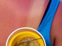 उन्हामुळे सनबर्नचा त्रास- टॅनिंगही वाढलं? जायफळाचा 'असा' लेप लावा, काळवंडलेली त्वचा होईल उजळ - Marathi News | how to get rid of tanning and sunburn, home hacks to reduce tanning and sunburn, how to use jaifal or nutmeg for skin care in summer | Latest sakhi Photos at Lokmat.com