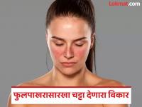 हा ब्लश नाही, महिलांना होणारा गंभीर आजार आहे; लुपस विकार ज्याने गर्भपातही होऊ शकतो - Marathi News | This is not a blush, it is a serious disease that affects women; Lupus disorder which can also cause miscarriage | Latest health Photos at Lokmat.com