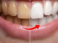 Teeth Whitening At Home : दातांवर पिवळा थर - हिरड्या काळ्या? १ सोपा उपाय- पिवळे पडलेले दात चमकतील मोत्यांसारखे... - Marathi News | How to whiten yellow teeth naturally at home yellow teeth remedy black gums treatment | Latest sakhi Photos at Lokmat.com