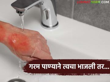 उकळते पाणी अंगावर पडल्यास लगेच घरच्याघरी करा 'हा' सोपा उपाय; जाणून घ्या सविस्तर - Marathi News | If boiling water falls on your body, immediately do this simple remedy at home; Know in detail | Latest News at Lokmat.com