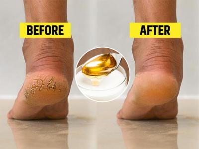 हिवाळ्यात फुटलेल्या टाचांसाठी ६ घरगुती उपाय! भेगाळलेल्या टाचाही होतील मुलायम, सुंदर - वेदना, दुखणे होईल कमी...