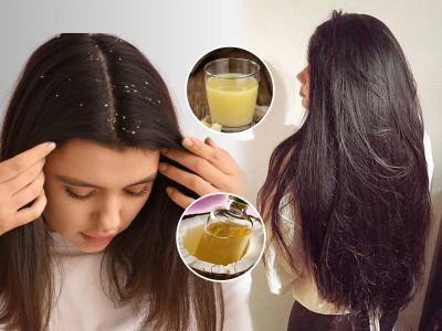 कोंड्यामुळे डोक्यात सतत खाज येते? जावेद हबीब सांगतात कोंडा घालवून टाकण्याचा भन्नाट उपाय