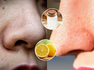 नाकावरचे ब्लॅकहेड्स, व्हाईटहेड्स ५ मिनिटांत हाेतील गायब, लगेच करा १ सोपा घरगुती उपाय