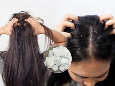 डोक्यातल्या कोंड्यामुळे हैराण हाेऊ नका, चमचाभर कापूर 'या' पद्धतीने वापरा- १ आठवड्यात कोंडा गायब