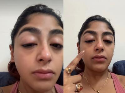 दात तुटला, डोळाही सुजला..., इन्फ्लुएन्सरच्या मित्राकडून अभिनेत्रीला मारहाण, नक्की काय घडलं?