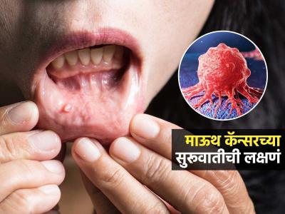 माऊथ कॅन्सरच्या सुरूवाची ७ लक्षणं; तोंड आलंय म्हणून दुर्लक्ष करण्याआधी लक्षणं ओळखा