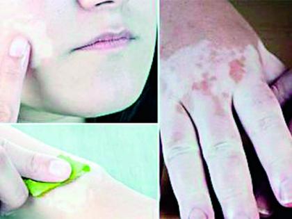 If there is code on the skin, where is the problem? | त्वचेवर कोड असेल तर बिघडले कोठे?