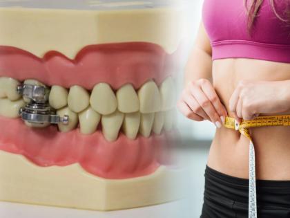 World first weight loss device dental slim diet control developed by researchers | जबरदस्त! वजन कमी करण्यासाठी चुंबकाचा खास जुगाड, दोन आठवड्यात ६ किलो वजन होतं कमी