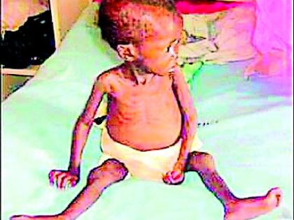 17% of children in Sironcha are malnourished | सिरोंचात १७ टक्के बालके कुपोषित