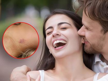 Love bite or hickeys side effects many people do not know about | त्वचेसाठी लव्ह बाइट ठरू शकतो घातक, इतका की तुम्ही विचारही केला नसेल!