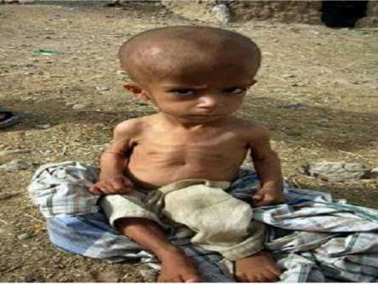 Two malnourished children in Dhule district | धुळे जिल्ह्यात ३५१ कुपोषित बालके Two malnourished children in Dhule district | धुळे जिल्ह्यात ३५१ कुपोषित बालके