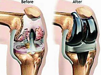 Sacral Knee Implant Surgery | साकोलीत गुडघा प्रत्यारोपण शस्त्रक्रिया