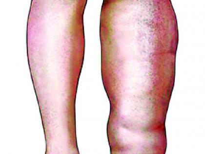 1,629 filaria disease patients in the taluka | तालुक्यात १ हजार ६२९ हत्तीरोग रूग्ण 1,629 filaria disease patients in the taluka | तालुक्यात १ हजार ६२९ हत्तीरोग रूग्ण