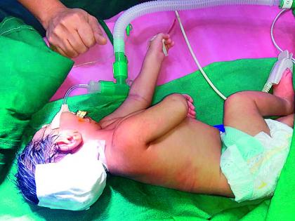 Successful surgery on one day's baby | एक दिवसाच्या बाळावर यशस्वी शस्त्रक्रिया, मेंदूशी संबंधित शस्त्रक्रियेने वाचवले बाळ