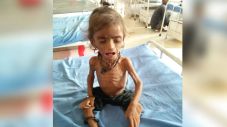Four times the number of malnourished children in four months | चार महिन्यात कुपोषित बालकांची संख्या चार पटीने Four times the number of malnourished children in four months | चार महिन्यात कुपोषित बालकांची संख्या चार पटीने