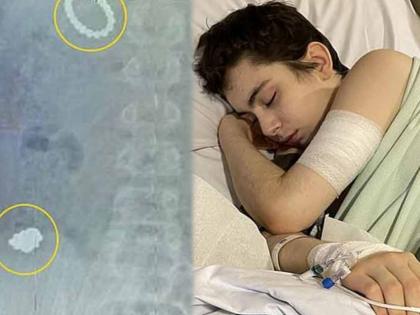 12 years old boy undergoes life saving operation after he deliberately swallowed 54 toy magnets to see if metal would stick to his stomach | आली लहर केला कहर! १२ वर्षीय मुलाने खाल्ल्या ५४ चुंबकाच्या गोळ्या, कारण वाचून व्हाल थक्क.....