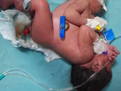 Siamese twins born in district hospital! | जिल्हा रुग्णालयात जन्मले सयामी जुळे ! Siamese twins born in district hospital! | जिल्हा रुग्णालयात जन्मले सयामी जुळे !