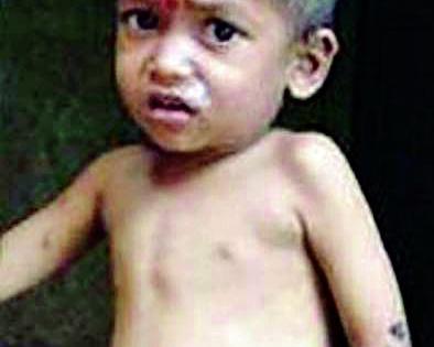 628 malnourished children | ६२८ बालके कुपोषित