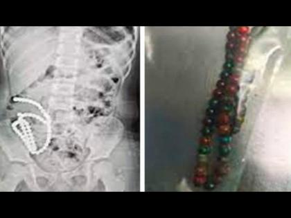 China : 61 toy magnetic beads in girls stomach surgeons removed x-ray photo viral | पोटात दुखत होतं म्हणून मुलीला हॉस्पिटलमध्ये केलं दाखल, X-RAY पाहून डॉक्टर हैराण