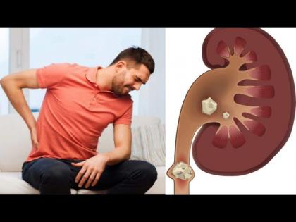 Health tips in the problem of kidney stone protect in this way | तुमची ही सवय ठरू शकते किडनी स्टोनचं कारण, वेळीच व्हा सावध!