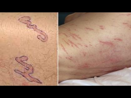 Terrible disease strange marks are being made at such places of the body difficult to treat | एका अजब आजारामुळे डॉक्टरही झाले हैराण, उपचार करणंही होत आहे अवघड