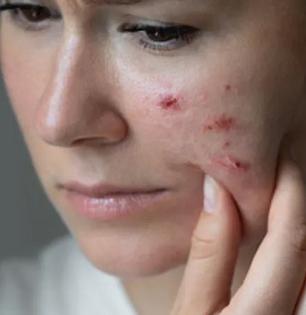 Skin Care Tips : तेलकट त्वचा, सतत पुटकुळ्या, वैतागलात? ४ गोष्टी चुकवू नका, प्रॉब्लेम गायब