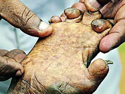 301 new leprosy detected in search operation | शोधमोहिमेत आढळले ३०१ नवीन कुष्ठरुग्ण