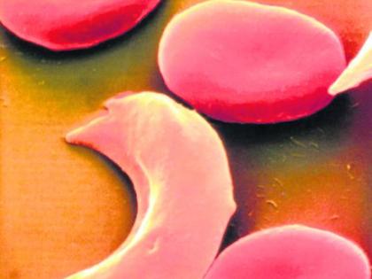 44 thousand children suffering from sickle cell in India | देशात ४४ हजार मुले सिकलसेलग्रस्त