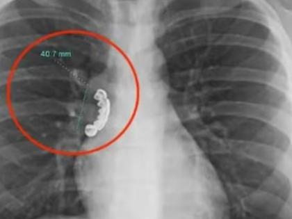 Man accidentally swallows dentures shows xray report | जेवण करताना चुकून नकली दात तरूणाच्या पोटात गेले, एक्स-रे पाहून डॉक्टर हैराण