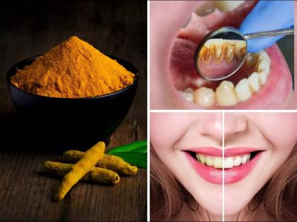 Ayurveda Dr told a effective ayurvedic home remedy to treat toothache yellow teeth | दातांची किड, वेदना आणि काळे कीटक मुळापासून नष्ट करेल हा सोपा आयुर्वेदिक उपाय