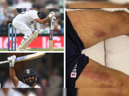 Ind vs Eng 4th Test 2021 Live updates: Condition of Rohit Sharma legs after yesterday's innings; photo viral | India vs England 4th test Live : कालच्या खेळीनंतर रोहित शर्माच्या मांडीची झालेली अशी अवस्था, क्रिकेट चाहत्यांनाच समजू शकतात या वेदना!