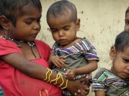 The resolution of malnutrition free district is welcome, but ... | कुपोषणमुक्त जिल्ह्याचा संकल्प स्वागतार्ह, पण... The resolution of malnutrition free district is welcome, but ... | कुपोषणमुक्त जिल्ह्याचा संकल्प स्वागतार्ह, पण...