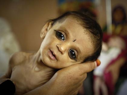 Increased number of severely malnourished children | तीव्र, अतितीव्र कुपोषणग्रस्त बालकांची वाढली संख्या