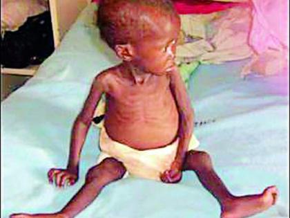 1,641 children in Melghat are severely malnourished | मेळघाटातील १६४१ बालके तीव्र कुपोषित