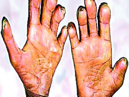 The district has 232 new leprosy patients | जिल्ह्यात २३२ नवीन कुष्ठरुग्णांची भर