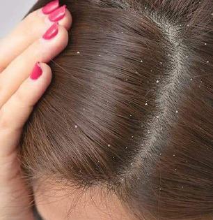 Home Remedy For Hair Dandruff Problem: केसात फार कोंडा झालाय, वैताग आलाय? स्वयंपाकघरातली 1 गोष्ट, कोंड्यावर उत्तम इलाज