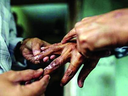 Detection of leprosy patients will go from house to house in Nagpur | नागपुरात घरोघरी जाऊन घेणार कुष्ठरुग्णांचा शोध