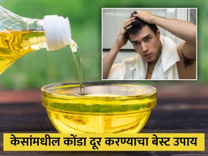 Camphor kapoor and lemon juice natural Ayurvedic remedies to control dandruff | डोक्यावर चिकटून बसलेला डॅंड्रफ होईल लगेच दूर, कापरासोबत मिक्स करा या 2 गोष्टी!