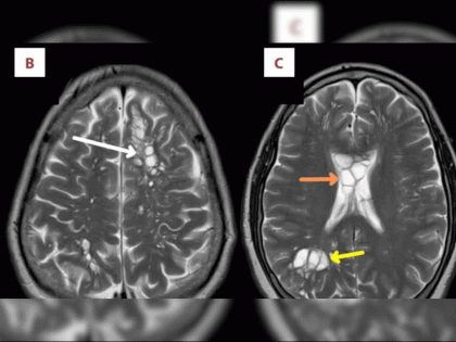 Tapeworm eggs larvae found in 52 year old us person brain linked to eating undercooked bacon pork | धक्कादायक! व्यक्तीच्या मेंदुत सापडली टेपवर्मची अंडी, जाणून घ्या यामागचं कारण...