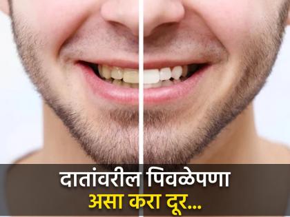 5 effective Ayurveda home remedies to remove yellow tartar from teeth | दातांवरील पिवळेपणा घालवण्यासाठी खास नॅच्युरल उपाय, तोंडाचा येणार नाही वास!