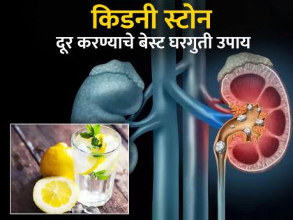 7 type of remedies that can flush out kidney stones without medicine | औषधांचा वापर न करता किडनी स्टोन करू शकता दूर, बेस्ट 7 घरगुती उपाय