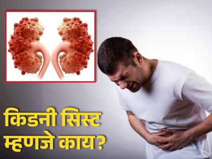 Signs, causes and symptoms of kidney cyst | 'या' गोष्टींवरून मिळतात किडनी सिस्ट झाल्याचे संकेत, जाणून घ्या काय आहे ही समस्या!