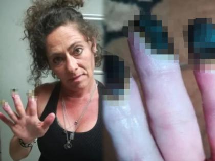 The harmful effects of smoking 15 cigarettes a day, See the condition of woman fingers | दिवसाला १५ सिगरेट ओढल्याचा घातक परिणाम; महिलेची अवस्था पाहून अंगावर काटा येईल